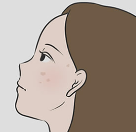 腫瘍の発生の可能性